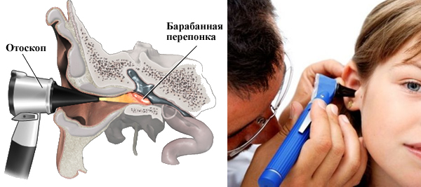 схема отоскопии